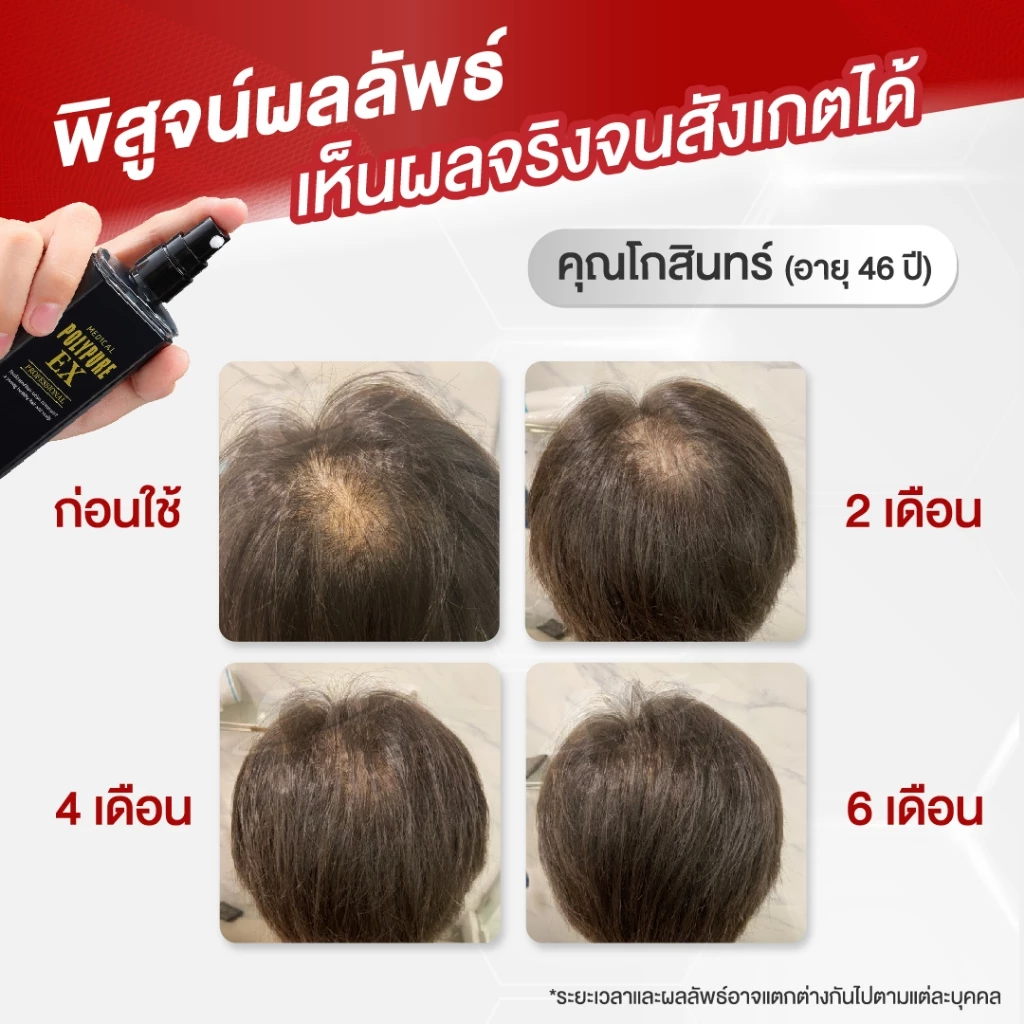 🇯🇵 POLYPURE EX โพลีเพียว อีเอ็กซ์ 120ml. เซรั่มปลูกผม ญี่ปุ่น ลดผมร่วง เพิ่มผมหนา (1 ขวด) thumbnail 5