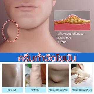 🔥ขายดี แท้ OUHOE🔥 ครีมทา ซี ส ก้อนไขมัน พร้อมส่งทั่ว ส่งไว ส่งฟรี