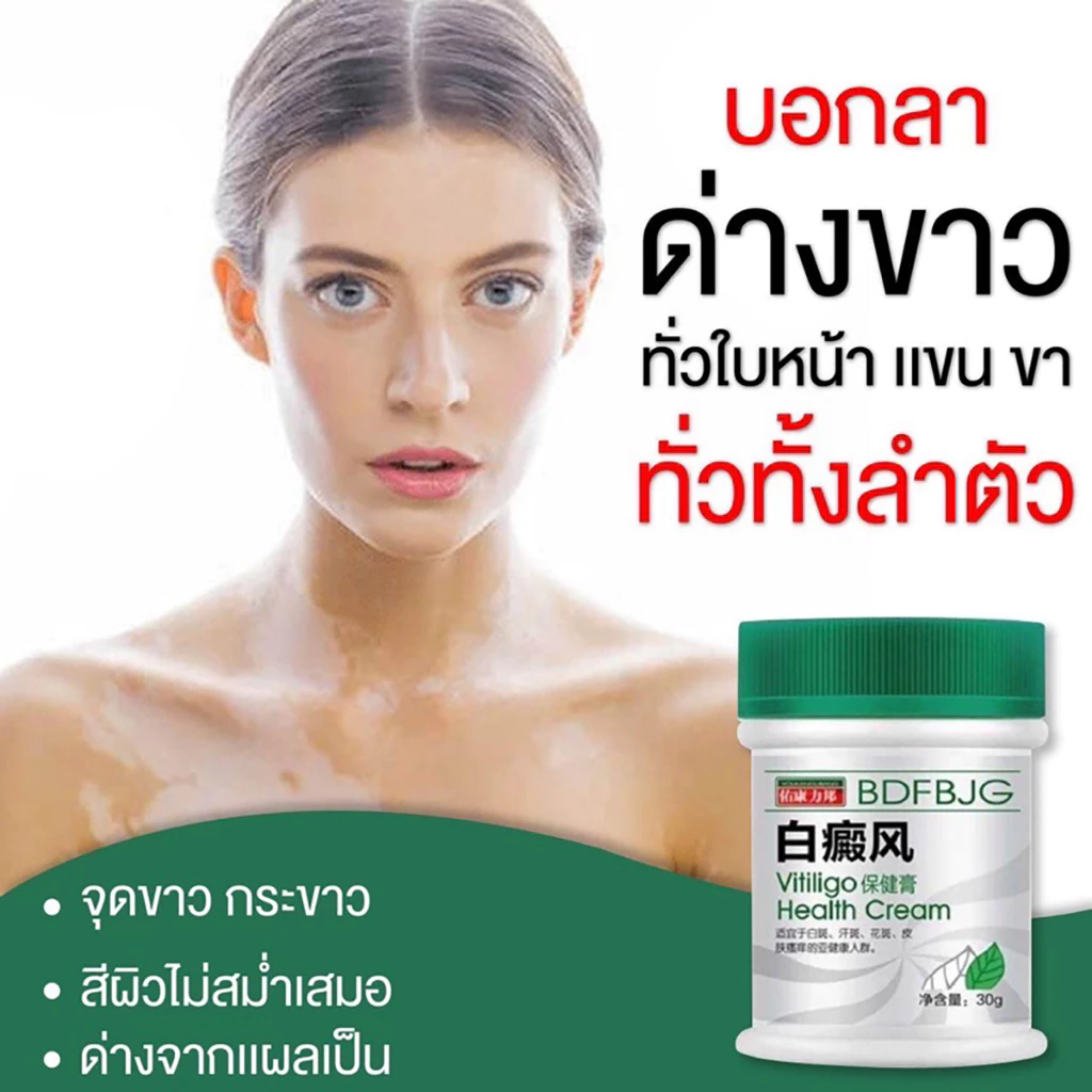 ครีมทาด่างขาว 30gด่างขาวบนใบหน้า มือ เท้า ด่างขาวจุดซ่อนเร้น ผลิตภัณฑ์กระตุ้นการสร้างเม็ดสีของผิว