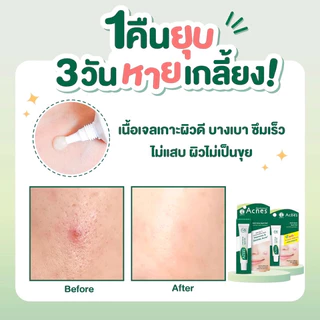 💕 Mentholatum Acnes Anti-Acne Spot Gel 5g/18g เมนโทลาทั่ม แอคเน่ส์ แอนไท แอคเน่ สปอต เจล 5กรัม/18กรัม เจลแต้มสิวฉุกเฉิน