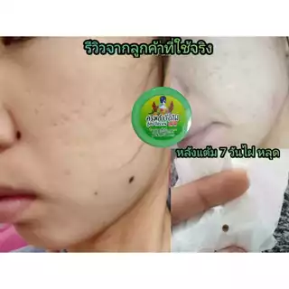 ครีมไฝ จีจี้ พร้อมส่ง ขี้แมลงวัน หูด ตาปลา ติ่งเนื้อ ของแท้ ไฝ ครีมแต้มไฝ