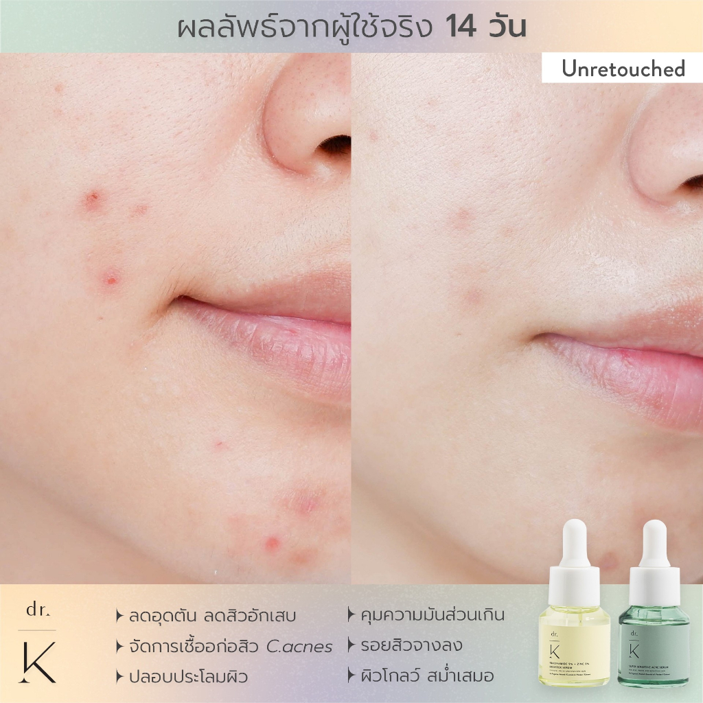 ลอตใหม่ (เซรั่มสิว หมอเก่ง) Dr.K super sensitive acne serum เซรั่มลดสิว สูตรอ่อนโยน สำหรับผิวแพ้ง่าย ราคา ถูกที่สุด ดีลบีเคเค แกลเลอรีภาพที่ 4