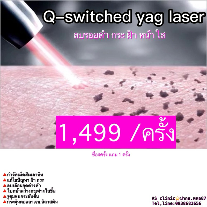 เลเซอร์ ฝ้า กระ รอยดำ รอยสิว หน้าขาวใส (q-switched yag laser)