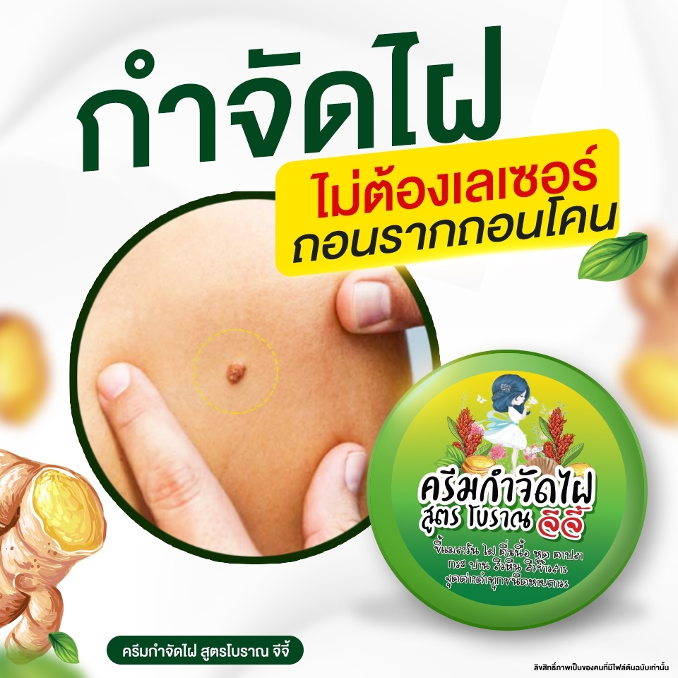 ครีมไฝจีจี้ ขี้แมลงวัน ติ่งเนื้อ หูด ตาปลา แก้ปัญหา กระ สิวหิน ไฝ หูด จี้หูด แต้มไฝ