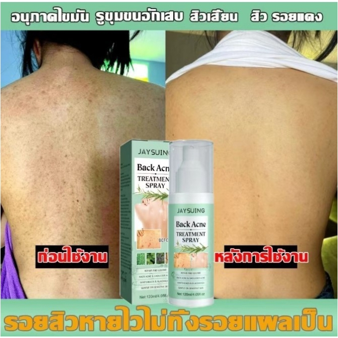 Jaysuing 120ml สิวที่หลัง แอคเน่ สเปรย์ฉีดแผ่นหลังและลำตัว ลดไรและสิวตามร่างกาย กำจัดสิวที่หลังและลำตัว ครีมแต้มสิว - รูปที่ 6