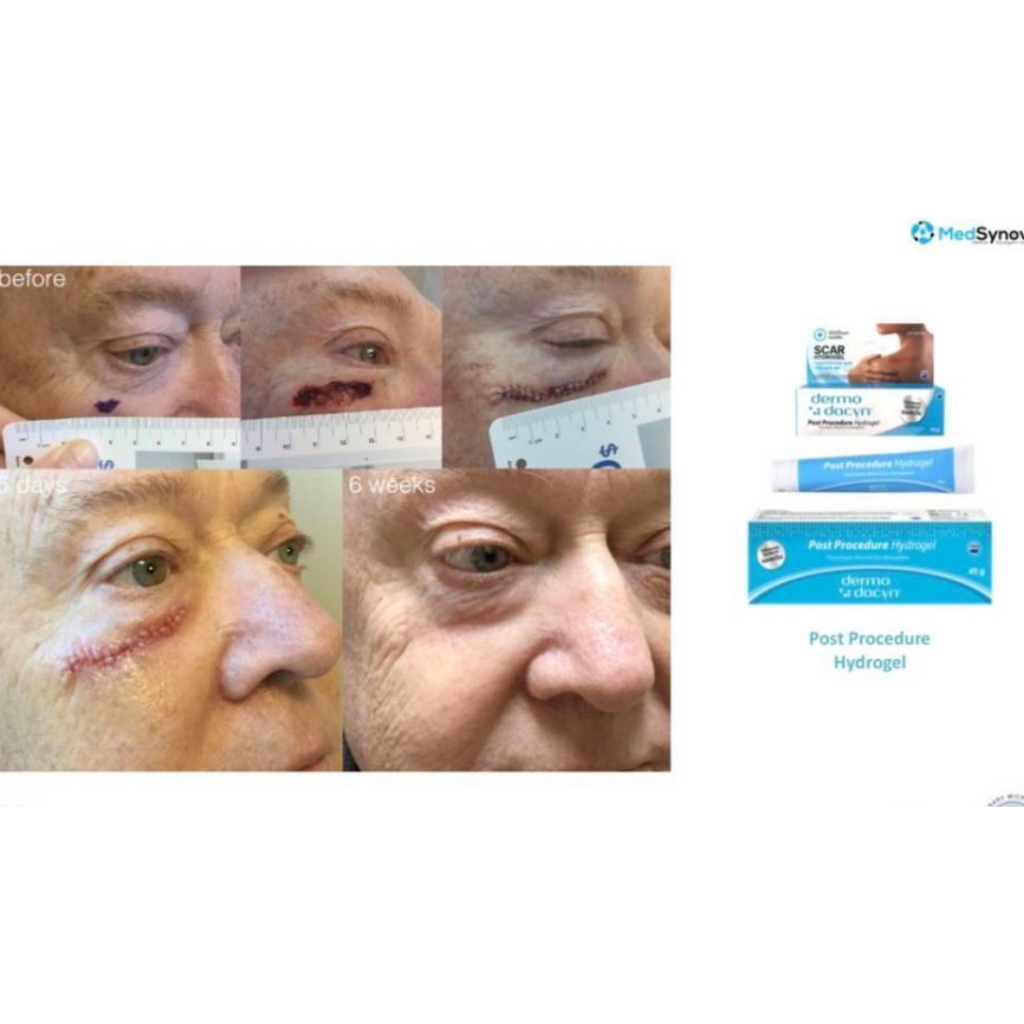 Dermodacyn Post Procedure Hydrogel เดอร์โมดาซิน โพสต์ รูปที่ 3