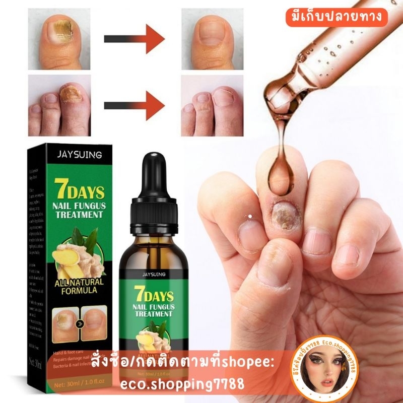 พร้อมส่ง ส่งถูก เซรั่มบำรุงเล็บ สูตรน้ำมันขิง ช่วยซ่อมเล็บ กำจัดเชื้อที่ราเล็บ 30ml. nail fungus ginger treatment