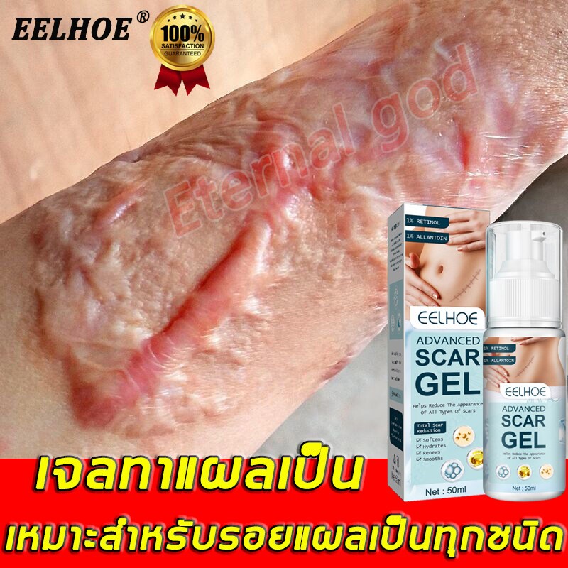 EELHOE ครีมทาแผลเป็น Gel For Scar 50ml เจล รอยแผลเป็น รอยสิว รอยดำ รอยแดง ทาแผลเป็นนูน ลบรอยแผลเปน Scar removal cream