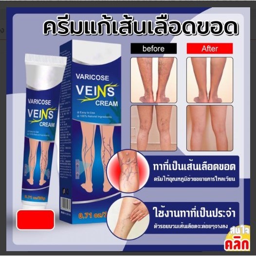 Varicose veins cream ครีมแก้เส้นเลือดขอด-ขนาด20g