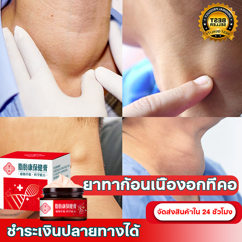 ครีมกำจัดก้อนซีส ครีมลดน้ำหนัก ครีมสลายไขมัน 30g กำจัดก้อน ก้อนเนื้อใต้ผิวหนัง ก้อนเนื้องอกไขมัน ก้อนไขมันแข็ง