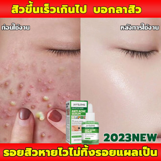 ลบสิวโดยไม่ทิ้งรอย สเปรย์ฉีดสิว ครีมลดสิว กำจัดสีว สิวอุดตันซ่อมแซมรอยสิวAcne cream ลดสิวถาวร ซ่อมแซมรอยสิว