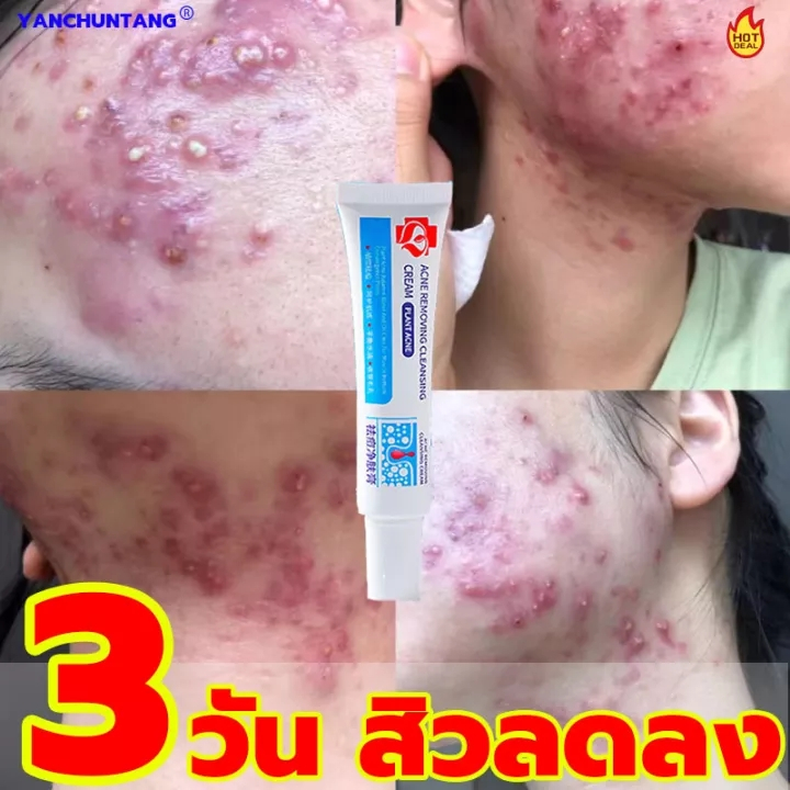 ครีมแต้มสิว สูตรเร่งรัด ANTI-ACNE Nature Effective Pureskin กำจัดสิวอย่างมีประสิทธิภาพ