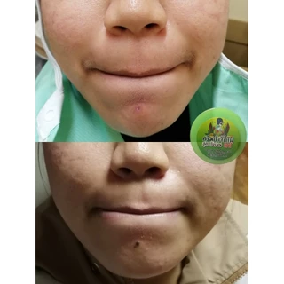 ครีมไฝจีจี้ ขี้แมลงวัน ติ่งเนื้อ หูด ตาปลา ไฝ แก้ปัญหา กระ สิวหิน ไฝ หูด จี้หูด แต้มไฝ