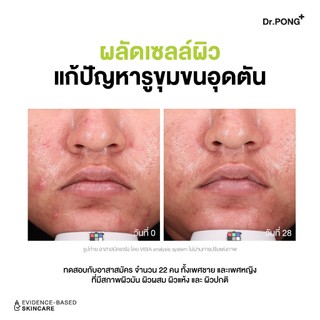 Dr.PONG P55 ACNE CLEAR FACE WASH เจลล้างหน้าลดสิว สูตรอ่อนโยน สิวลดจริง ลดการอุดตัน ยืนยันด้วยงานวิจัย