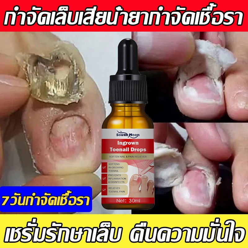OEDO รักษาเชื้อราเล็บขบ ยาทาฆ่าเชื้อราที่เล็บ