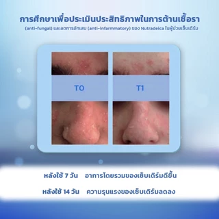 ISDIN Nutradeica® DS Facial Gel Cream เจลครีม ดูแลผิวเซ็บเดิร์มและสิวจากการ ใส่ mask ผิวชุ่มชื้น ปรับสมดุลผิว ลดอาการคัน