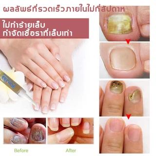 EELHOE เซรั่มบำรุงเล็บ ดูแลเล็บเสีย ซึมง่าย ใช้งานสะดวก