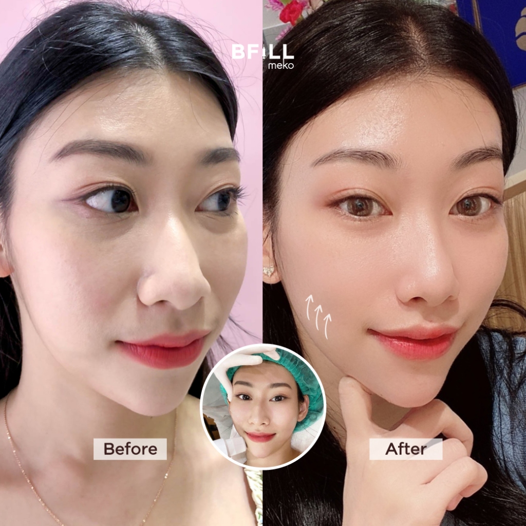 DUO Set Premium Hifu + Thermage Korea By Specialist เซตคู่หู ยกกระชับ พรีเมียมไฮฟู่ + เทอมาจเกาหลี ทำโดยผู้เชี่ยวชาญ