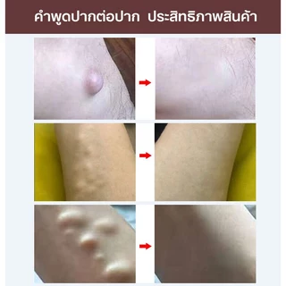 ก้อนเนื้อใต้ผิวหนัง ก้อนเนื้องอกไขมัน 30g กำจัดเนื้องอกไขมัน ก้อนเนื้อใต้ผิวหนัง