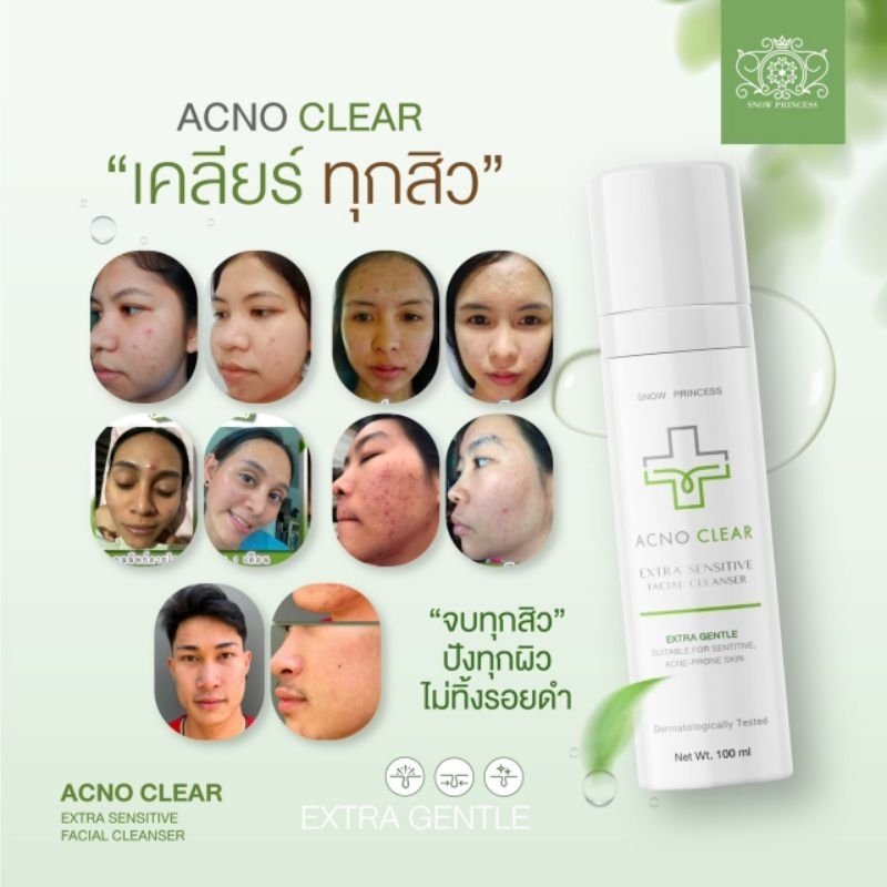 acno clear เจลล้างหน้าลดสิว