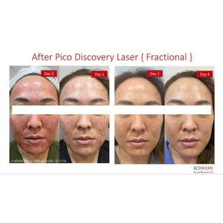 ECTODERM Scar and Restoration รักษาแผลตั้งแต่แรก แผลใหม่แผลหลังผ่าตัดสมานแผลแท้+แถม EXP.15/05/28