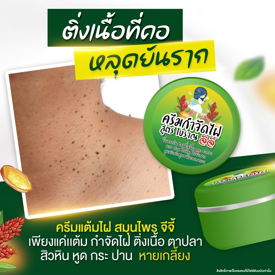 ครีมไฝจีจี้ ขี้แมลงวัน ติ่งเนื้อ หูด ตาปลา แก้ปัญหา กระ สิวหิน ไฝ หูด จี้ไฝ แต้มขี้แมลงวัน