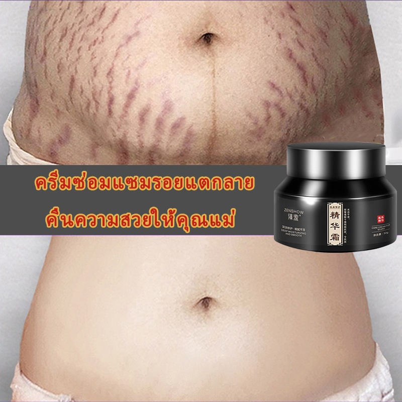 รอยแตกลาย ลดรอยแตกลาย ครีมทารอยแตกลาย 50g ลดเลือนรอยแตกลาย ครีมทาท้องลาย ครีมลดรอยแตกลาย ครีมทาท้อง ลดรอยแตกลาย