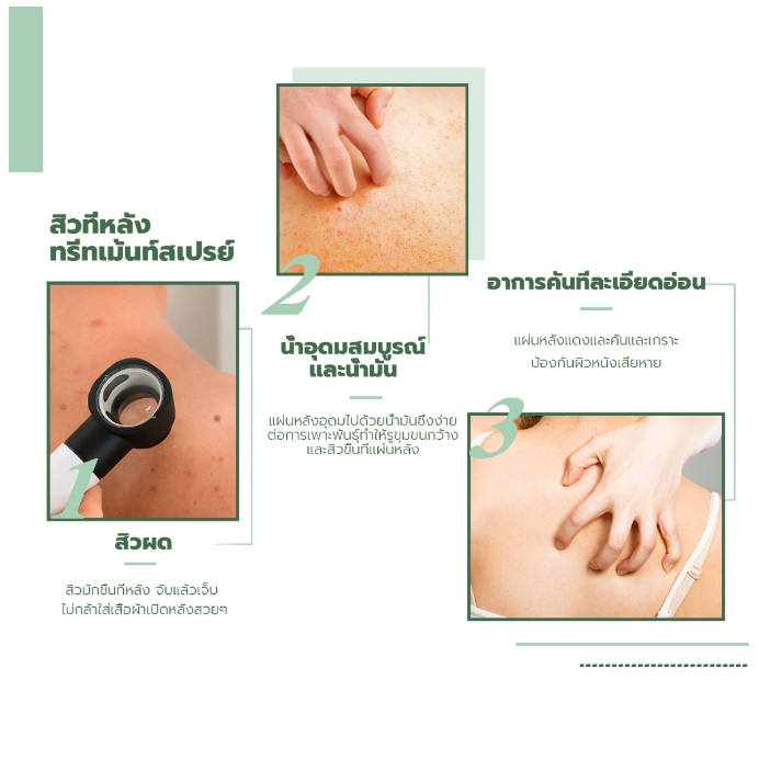 Jaysuing 120ml สิวที่หลัง แอคเน่ สเปรย์ฉีดแผ่นหลังและลำตัว ลดไรและสิวตามร่างกาย กำจัดสิวที่หลังและลำตัว ครีมแต้มสิว - รูปที่ 7