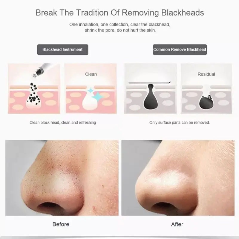 เครื่องดูดสิวไฟฟ้า ปรับระดับได้ ดูดสิวเสี้ยน สิวอุดตัน สิ่งสกปรก สุดคุ้ม! แถมฟรีหัวดูด 3 ชิ้น - รูปที่ 5