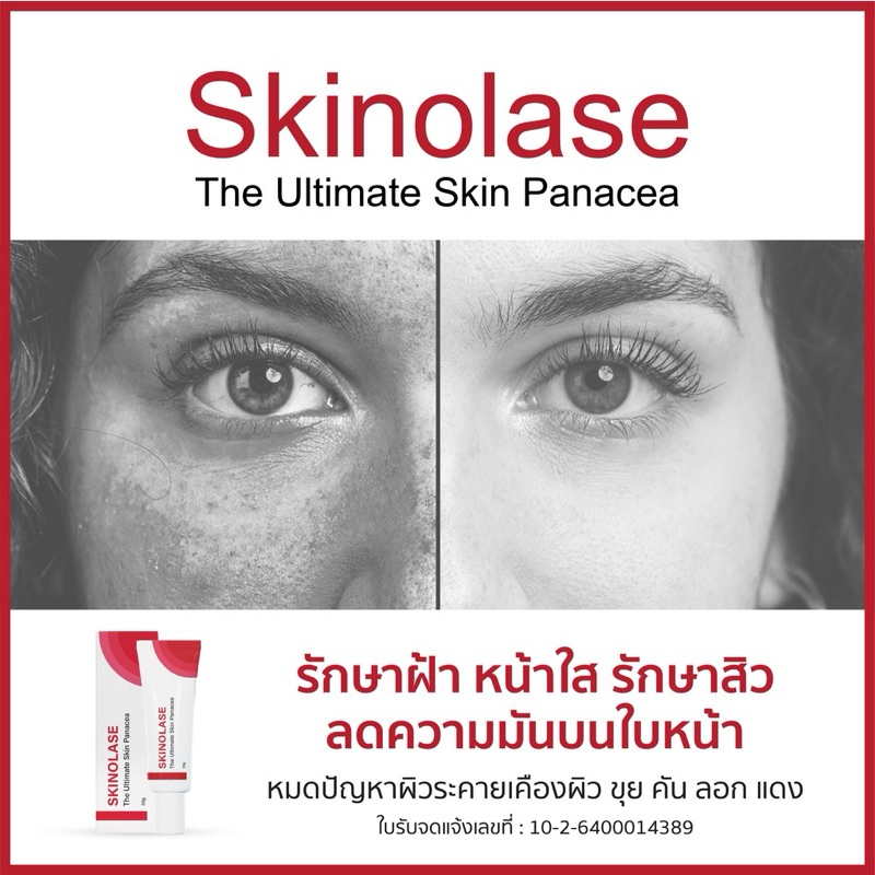 Skinolase (Azeloyl Diglycinate) รักษาฝ้า หน้าใส รักษาสิว