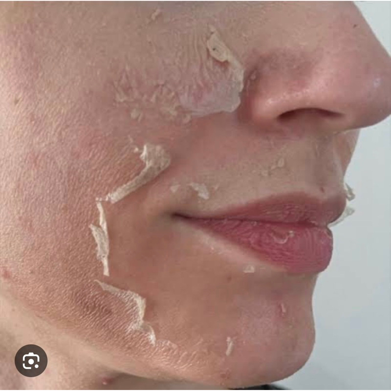 ชุดลอกฝ้า คลีนิค Derma Skin