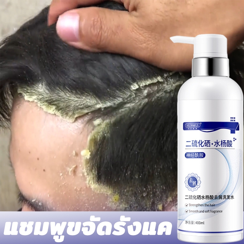 HUNMUI แชมพูขจัดรังแค 400ml ขจัดรังแค หยุดอาการคัน ควบคุมความมัน ยาสระผมแก้คัน ยาสระผมรังแค คันหนังศีรษะ