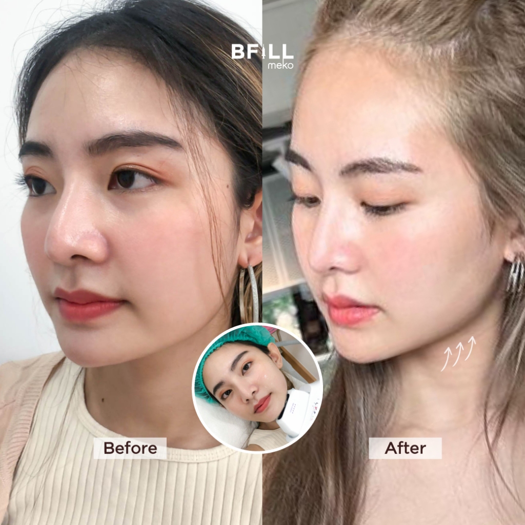 DUO Set Premium Hifu + Thermage Korea By Specialist เซตคู่หู ยกกระชับ พรีเมียมไฮฟู่ + เทอมาจเกาหลี ทำโดยผู้เชี่ยวชาญ