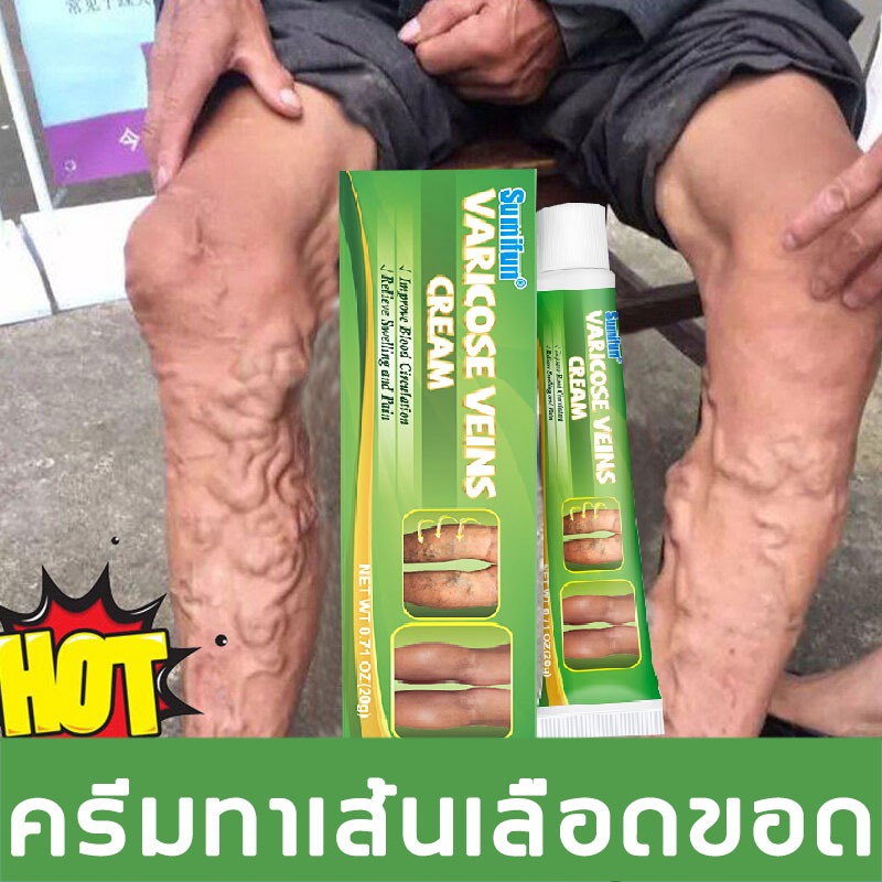 ไม่ได้ผลคืนเงิน ครีมทาเส้นเลือดขอด ส่งเสริมการไหลเวียนของเลือด รักษาขาให้สวย ครีมเส้นเลือดขอด ขนาด 20กรัม