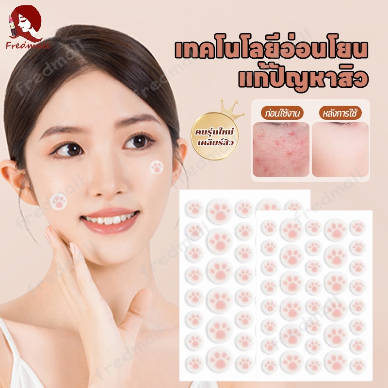 แผ่นสิว สําหรับติดตกแต่งสิว แผ่นแปะดูดสิว แผ่นสติกเกอร์แปะสิว แผ่นดูดสิวน่ารักอุ้งเท้าแมว กันน้ำ