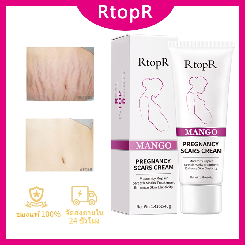 RtopR FDA มะม่วงครีมบํารุงผิว ลดรอยแผลเป็น รอยแตกลาย ครีมทาท้องลาย ลดรอยแตกลาย ท้องลาย ริ้วรอยจากการตั้งครรภ์ 40 กรัม