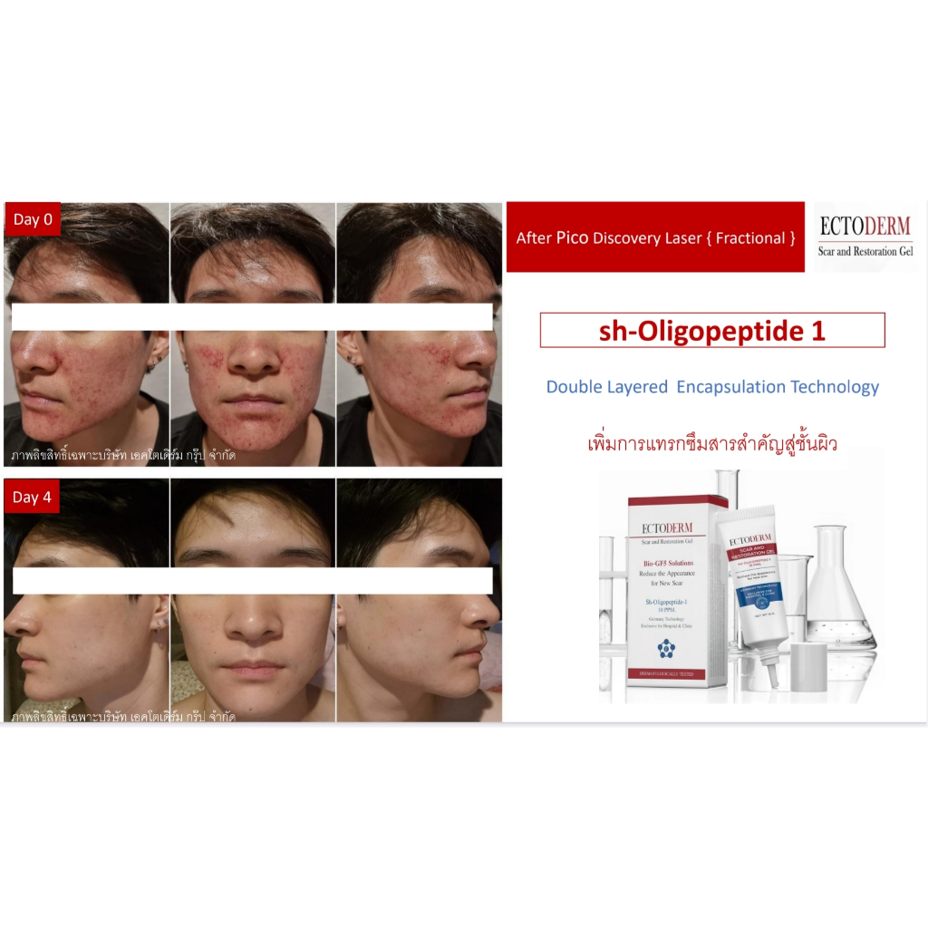 ECTODERM Scar and Restoration Gel +แถม ของแท้ จำหน่ายโดยคลินิก ผลิตภัณฑ์ที่ช่วยสมานแผล Exp.07/01/202