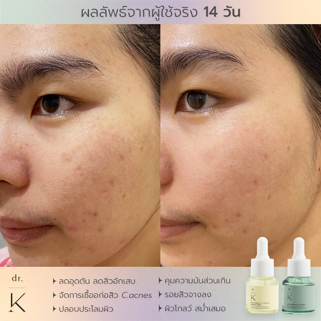 ลอตใหม่ (เซรั่มสิว หมอเก่ง) Dr.K super sensitive acne serum เซรั่มลดสิว สูตรอ่อนโยน สำหรับผิวแพ้ง่าย ราคา ถูกที่สุด ดีลบีเคเค แกลเลอรีภาพที่ 6