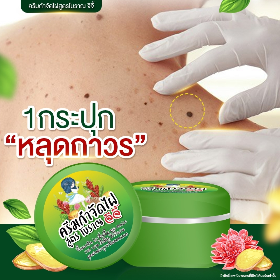ครีมไฝจีจี้  ติ่งเนื้อ ขี้แมลงวัน หูด ตาปลา ไฝ แก้ปัญหา กระ สิวหิน ไฝ หูด จี้หูด แต้มไฝ
