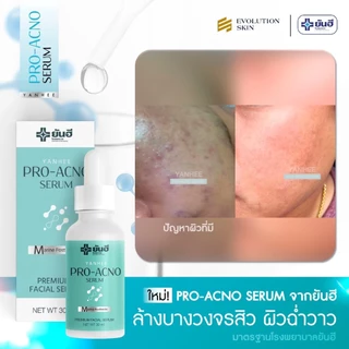 Yanhee Pro Acno Serum [1 ขวด] ยันฮี โปร-เอกโน่ เซรั่มยันฮีลดสิว ลดรอยดำจากสิว ลดรอยแดงจากสิว ลดสิวอักเสบ ผิวแพ้ง่าย