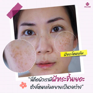8G l ครีมทาฝ้า ลดฝ้า Melamii Anti-Melasma Perfect White Serum and Spot Corrector