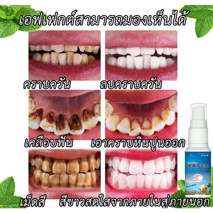 น้ำยากำจัดคราบหินปูนทำความสะอาดฟัน 30 มล. ทำความสะอาดฟันพร้อมส่งในก.ท.ม.