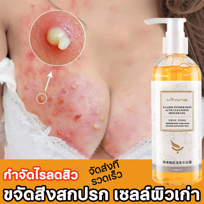 HYQING ครีมอาบน้ําลดสิว ครีมอาบน้ำกำจัดไร Body Wash 260ML กำจัดไรลดสิว ต่อต้านเชื้อราแก้คัน ผิวเรียบเนีย สิว กลากคัน