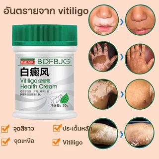ครีมทาด่างขาว 30gด่างขาวบนใบหน้า มือ เท้า ด่างขาวจุดซ่อนเร้น ผลิตภัณฑ์กระตุ้นการสร้างเม็ดสีของผิว