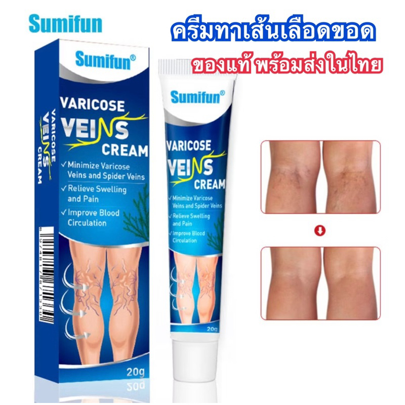 ครีมทาเส้นเลือดขอด ปูด บวม 2หลอด ขนาดรวม40g [พร้อมส่งในไทย]