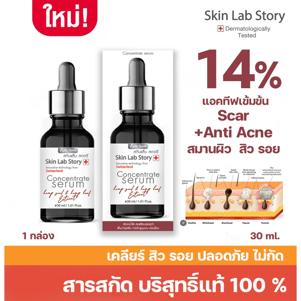 skinlab story เซรั่มเข้มข้น  L5  *ฝาดำเนื้อขุ่น จบสิว 30 ml. ให้ผิวดูกระจ่างใส คุมมันสำหรับผู้มีรอยสิวผิวมัน เป็นสิวง่าย