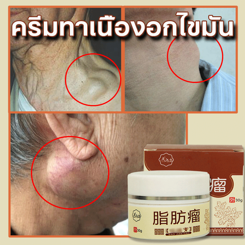 ครีมทาก้อนเนื้องอกไขมัน ครีมกำจัดก้อนซีส กำจัดเม็ดไขมัน 30g กำจัดก้อนไขมันใต้ผิวหนังอย่างปลอดภัยไม่เจ็บ