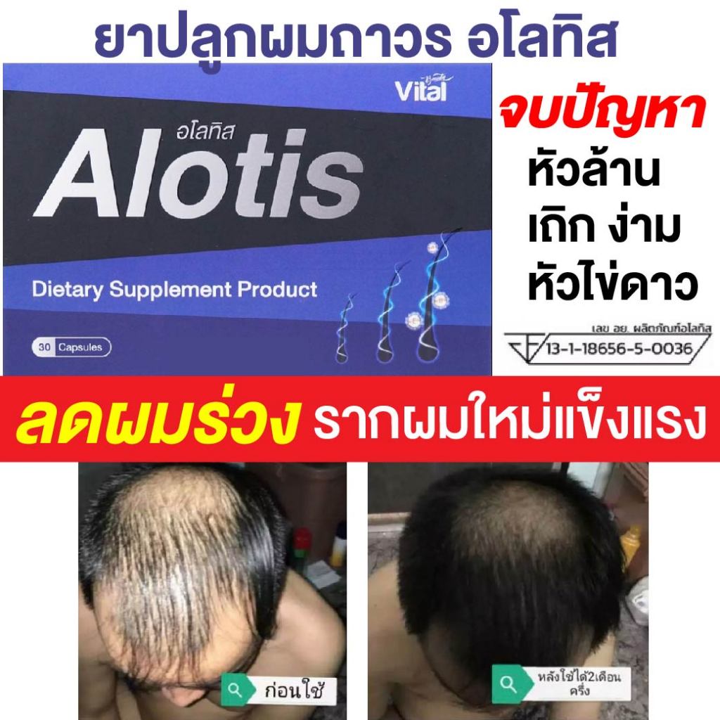 ยาปลูกผม Alotis อโลทิส ปลูกผม ลดผมร่วง ลดผมบาง หัวล้าน หัวเถิกไข่ดาว รากผมแข็งแรง เห็นผลจริง มีรีวิว