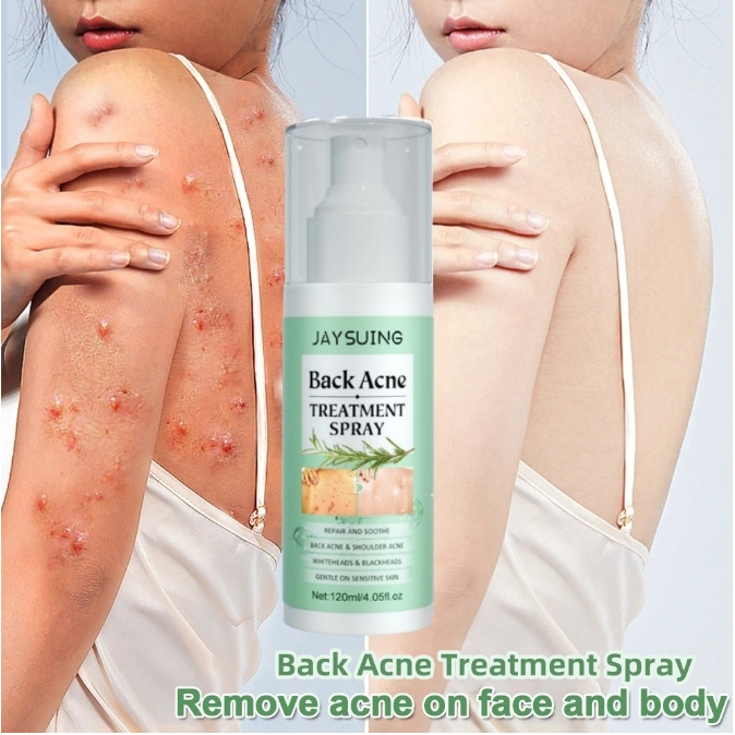Jaysuing 120ml สิวที่หลัง แอคเน่ สเปรย์ฉีดแผ่นหลังและลำตัว ลดไรและสิวตามร่างกาย กำจัดสิวที่หลังและลำตัว ครีมแต้มสิว - รูปที่ 5