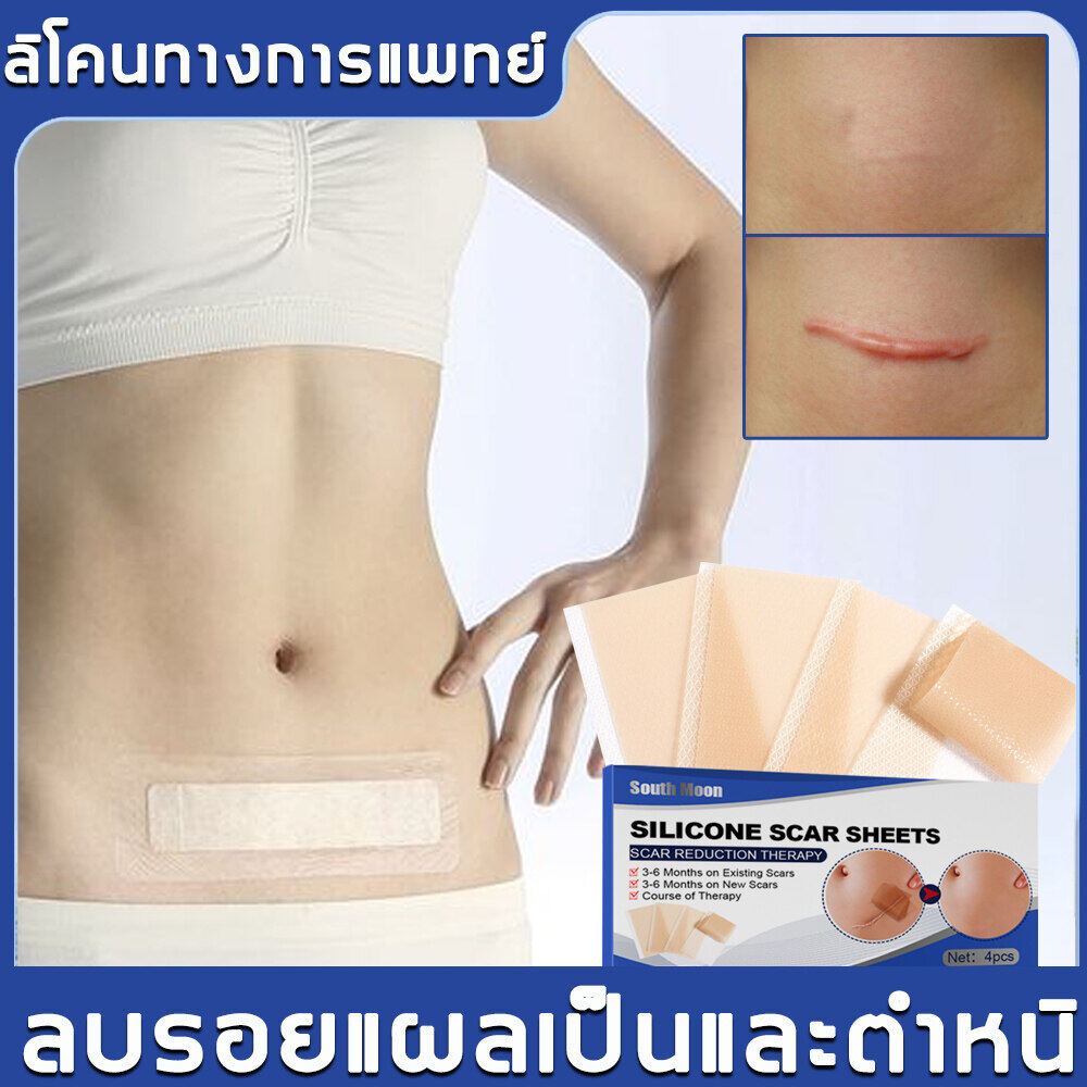 south moon แผ่นแปะแผลเป็น เจลปิดแผลเป็น แผ่นแปะซิลิโคนเจลลบรอยแผลเป็นสำหรับลบรอยแผลเป็น แผลเป็น การผ